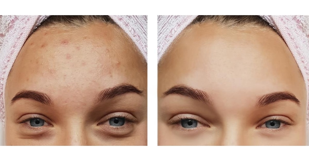 Which tool is Used to Remove the Imperfections in the Image like Spots and Scars