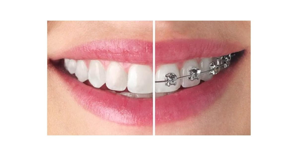 Braces Removal Photo Editor