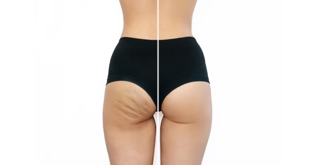 Edit Cellulite Photoshop