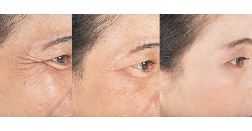 Face Wrinkles Retouching