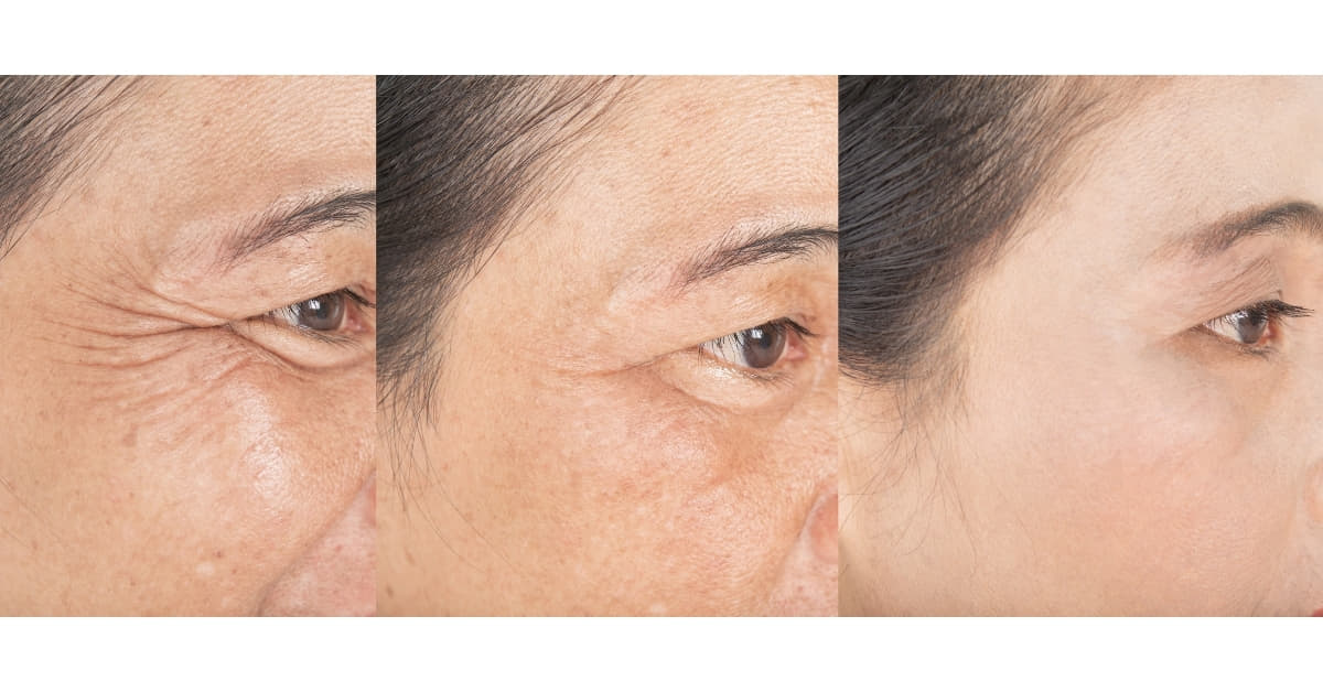 Face Wrinkles Retouching