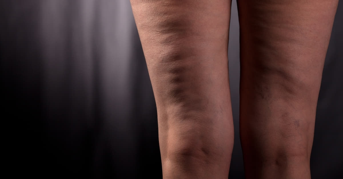 How To Edit Cellulite In Photoshop