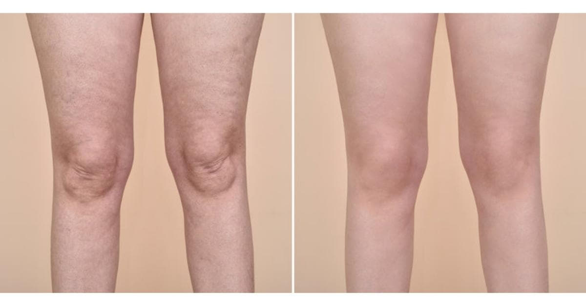 Remove Cellulite Photoshop