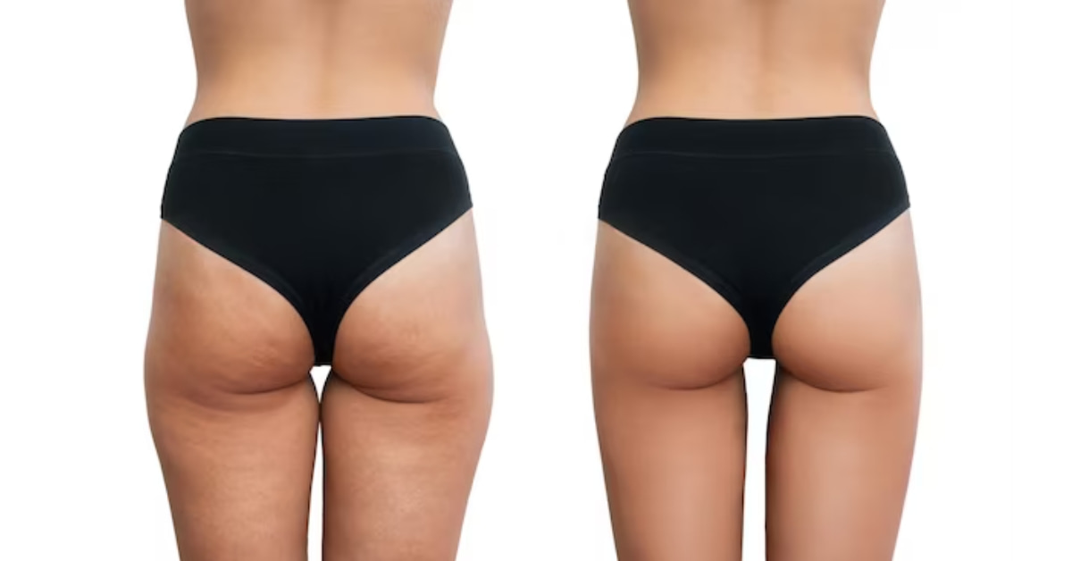 Remove Cellulite in Photoshop