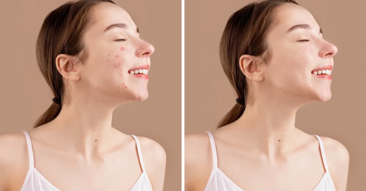 Photo Editor to Remove Blemishes
